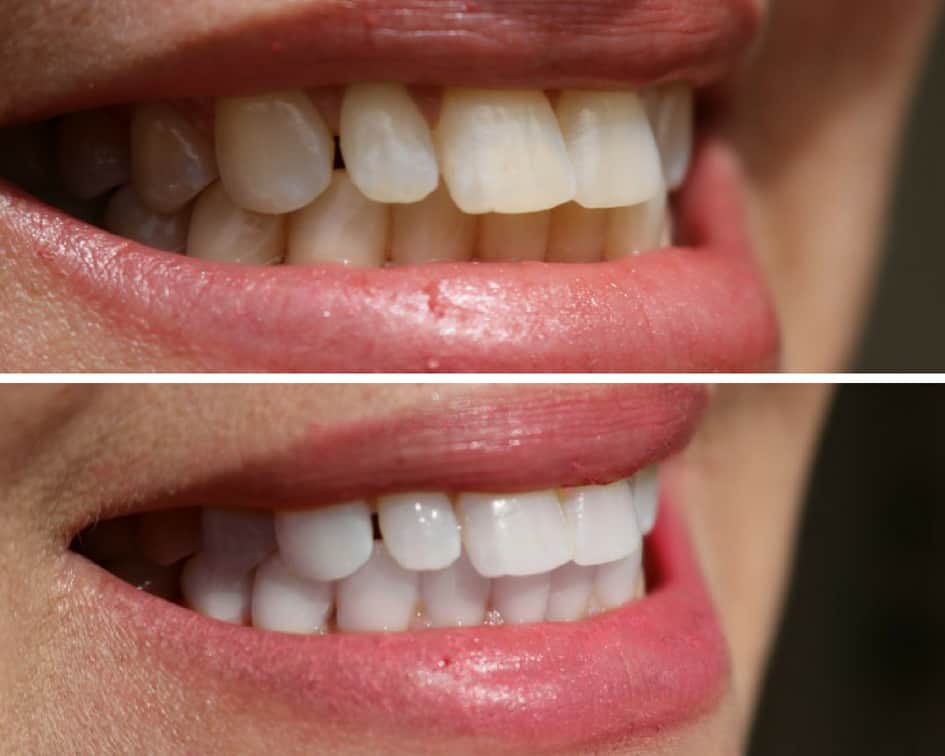 Before & After using Smile Brilliant Side