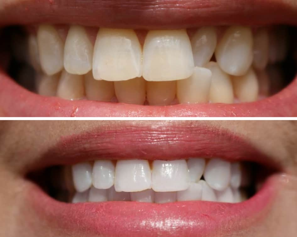 Before & After using Smile Brilliant